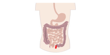 Decoding Crohn's Disease

Photo Courtesy